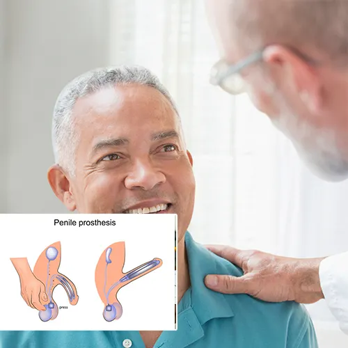 Embarking on Your Penile Implant Journey with  Urologist Houston 
